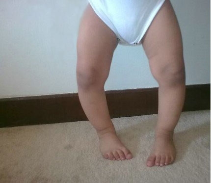 bebeklerde parantez bacak nedir cosmofoni